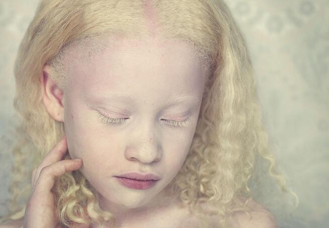 Albino Nedir Albino Hastaligi Genetik Mi