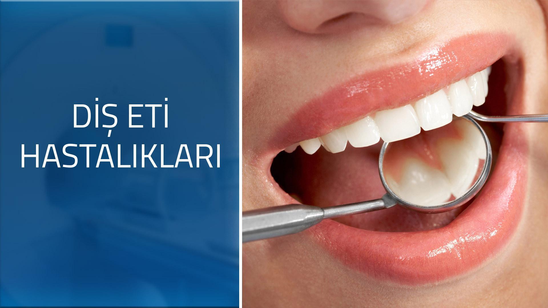 Geçmeyen diş eti iltihabı