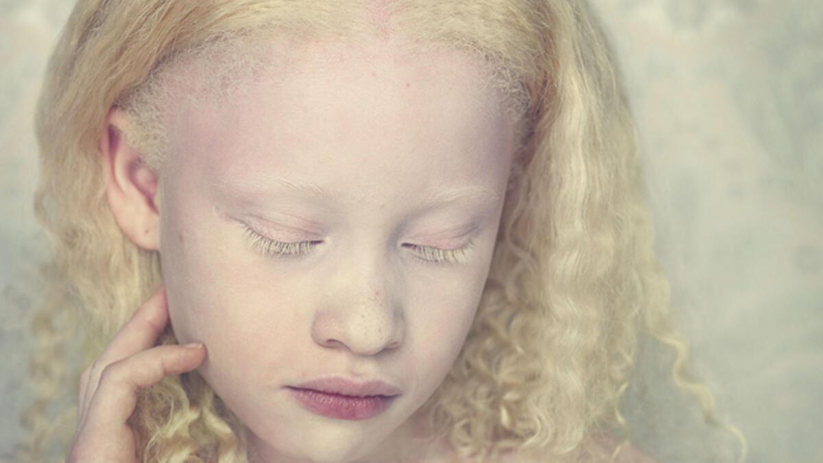 albino nedir albino hastaligi genetik mi