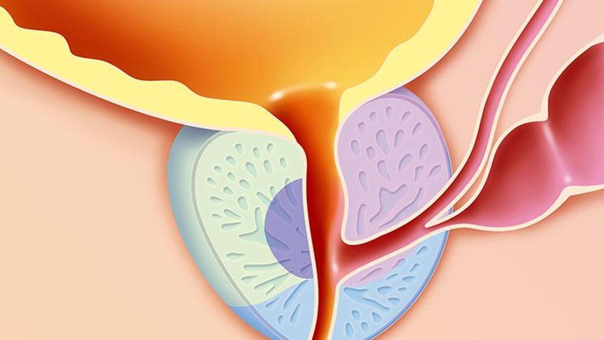 Prostat Kanseri Nasıl Tedavi Edilir 5455