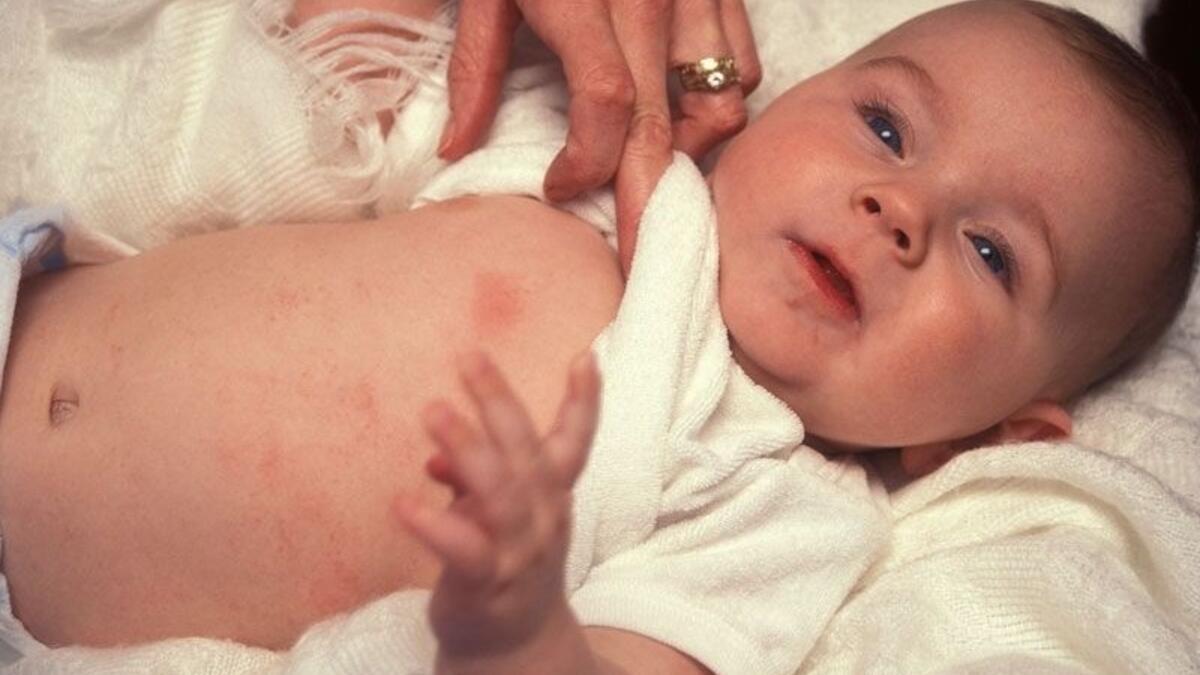 холодовая аллергия у ребенка фото