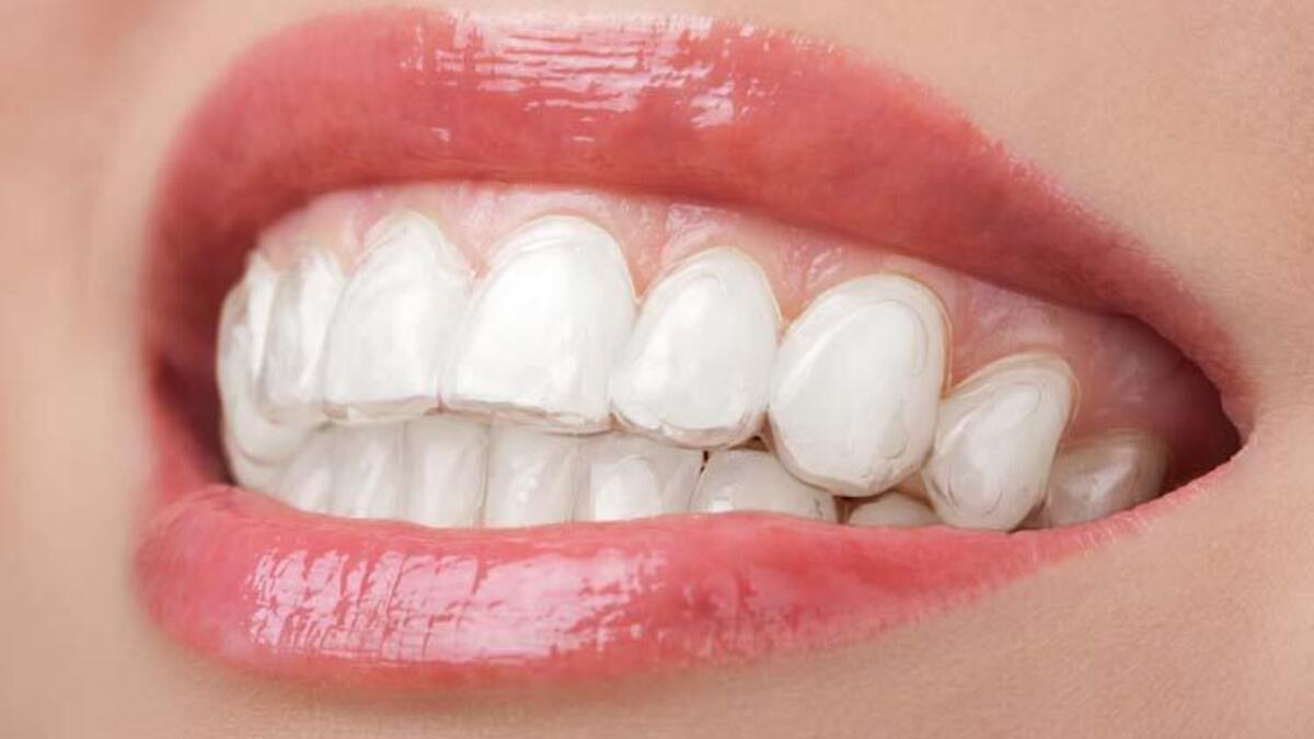 ameliyatsiz gummy smile tedavisi