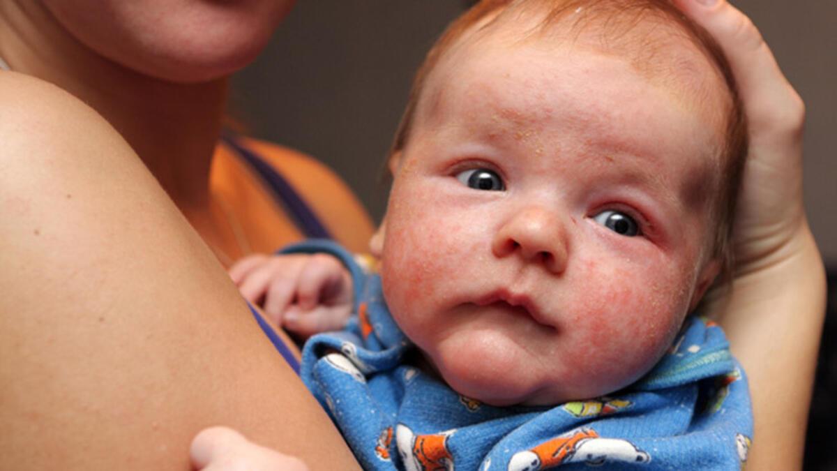 bebeklerde yumurta alerjisi neden olur nasil tedavi edilir