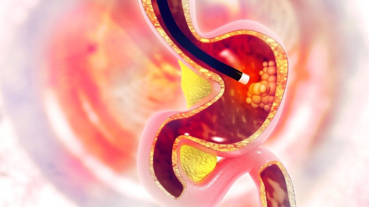 Endoskopi nedir, nasıl yapılır? Endoskopi öncesi hazırlık ve endoskopi