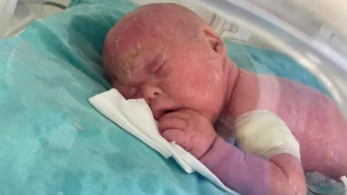 Harlequin İchthyosis (İktiyozis) nedir? - Son Dakika Haberleri İnternet