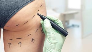 Çok popüler ve çok riskli: Brezilya poposu ameliyatı