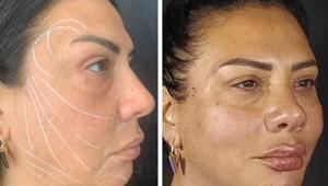 Dış görüntümün yaşlanmasını istemiyorum dedi...  Işın Karaca bıçak altına yattı