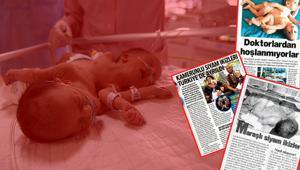 İki kafa ve üç kolla doğan bebekler şaşkına uğrattı... Merak edilenleri Türk doktor anlattı