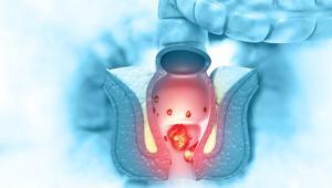 Bu iki hastalığın belirtilerini ayırt etmek çok zor... ‘Hemoroidim olduğunu düşünmüştüm, dördüncü evre kolon kanseri teşhisi kondu’