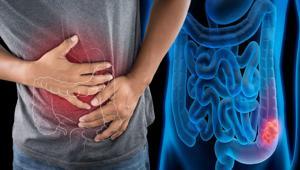 Korkutan rapor: Kolon kanseri gençlerin hastalığı oluyor Hastalığın yaşı neden bu kadar düştü ‘Bu durum endişe verici’