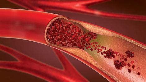 Yoksa sorun damarlarda mı