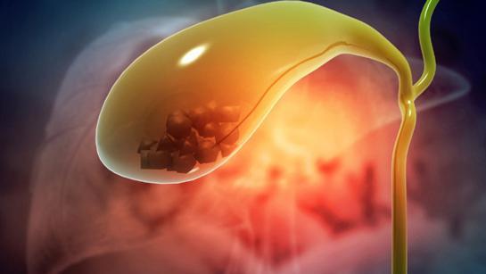 Safra kesesi taşı nedir, neden olur? İşte safra kesesi taşı belirtileri 