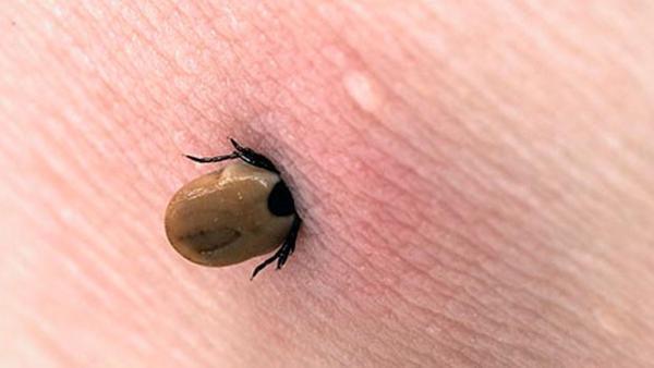 Lyme Hastaligi Nedir Lyme Hastaligi Belirtileri Nelerdir