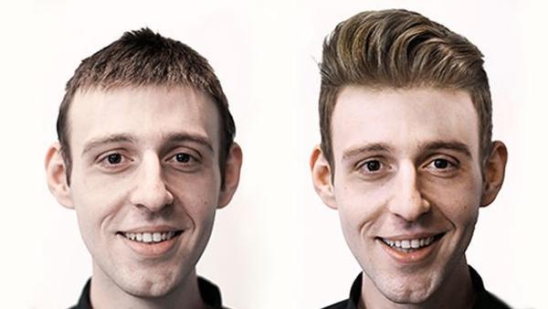 Erken Yaşta Saç Dökülmesi