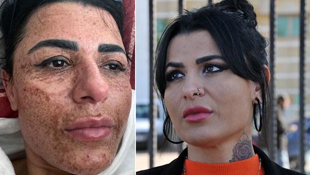 Antalya'da yüz yakan lazer uygulamasına şaşırtan ceza