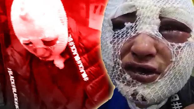 Hatay'da eski sözlüsüne cinsel saldırıda bulunup başından aşağı kızgın yağ döken şüpheli tutuklandı