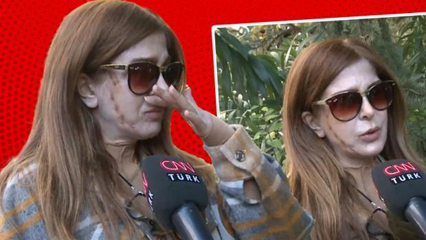 'Fransız askısı' estetiği yüzünden etti! Hayatı alt-üst oldu