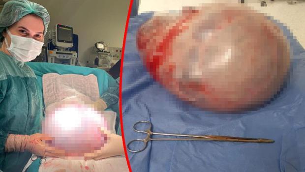 Karın şişliği şikayetiyle gitti, doktorlar da şaşırdı: Karnından 9 kiloluk tümör çıktı
