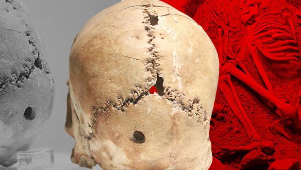 Dünyanın ilk beyin ameliyatında şaşırtan detay!