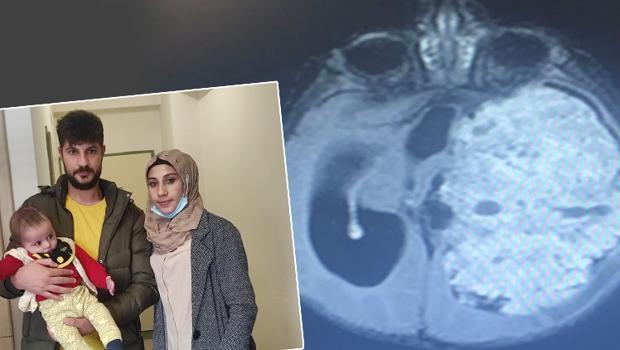 3 aylık bebeğin beynini saran tümör temizlendi