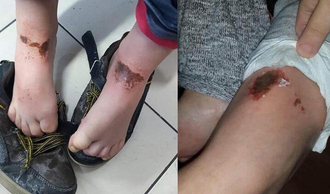 Afyonkarahisar'daki 'gizemli yanıklar'ın nedeni belli oldu Afyonkarahisar'daki 'gizemli yanıklar'ın nedeni belli oldu