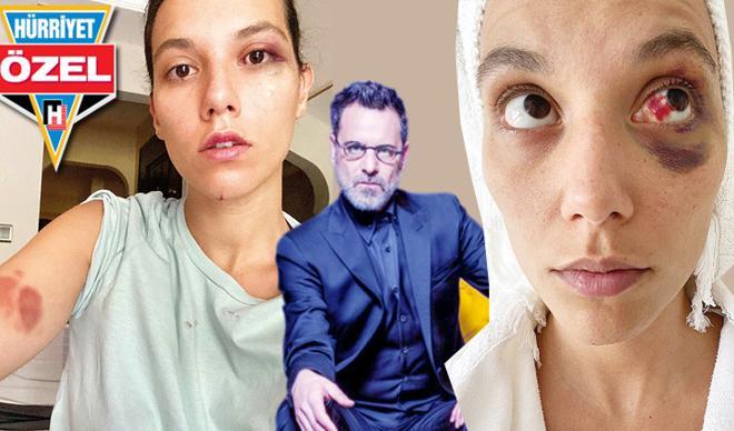 Son dakika haberi... Deniz Bulutsuz'un fotoğrafı şok etti: Ozan Güven beni böyle dövdü Son dakika haberi... Deniz Bulutsuz'un fotoğrafı şok etti: Ozan Güven beni böyle dövdü