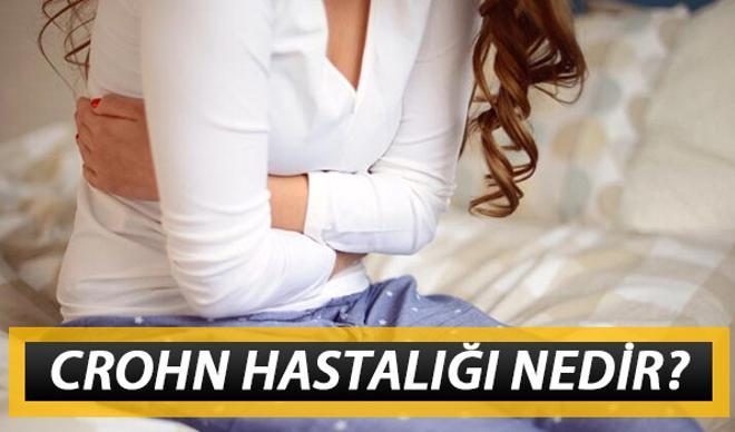 Crohn hastalığı nedir? Bensu Soral'ın hastalığı crohn belirtileri ve tedavisi hakkında bilgiler Crohn hastalığı nedir? Bensu Soral'ın hastalığı crohn belirtileri ve tedavisi hakkında bilgiler
