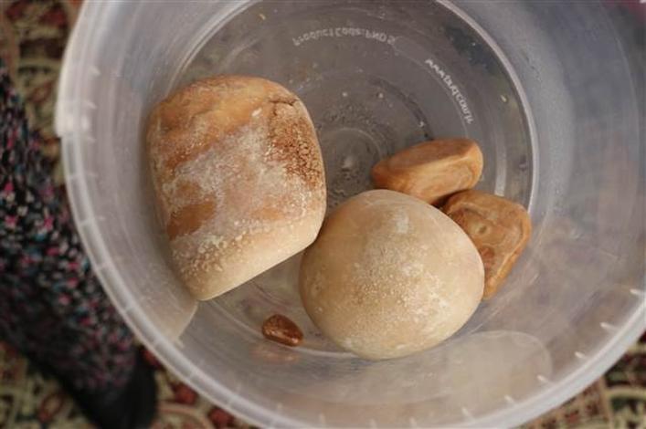 73 yaşındaki hastanın mesanesinden 2 kilo taş çıktı