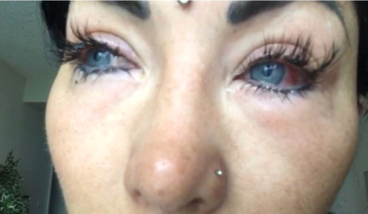 Unlu Isme Sok Goz Rengini Degistirmek Isterken Gozunden Oldu Haberler Unlu Isme Sok Goz Rengini Degistirmek Isterken Gozunden Oldu Haberler