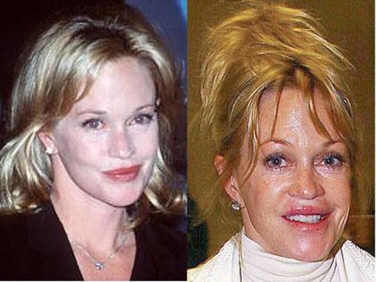 Фото неудачные пластические операции знаменитостей до и после