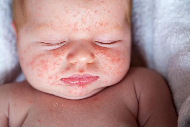 Besin Alerjileri Cocuklarda Daha Sik Gorulur