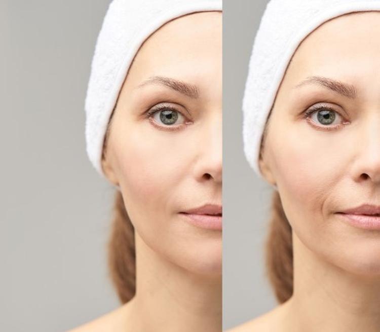 Goz Alti Torbalari Kimlerde Daha Cok Olusur Mahmure Goz Alti Torbalari Kimlerde Daha Cok Olusur Mahmure