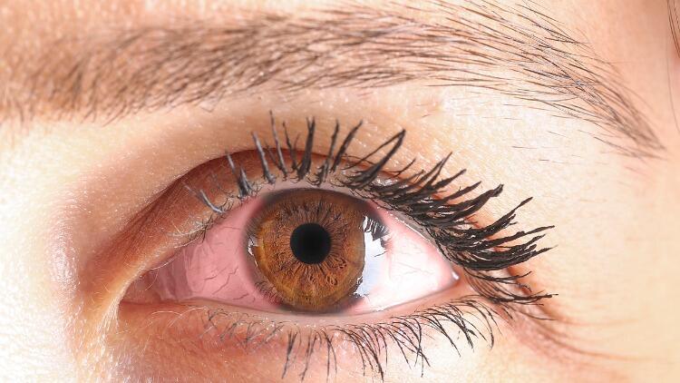 Göz kanlanması neden olur, nasıl geçer? Evde göz kanlanmasına iyi gelen
