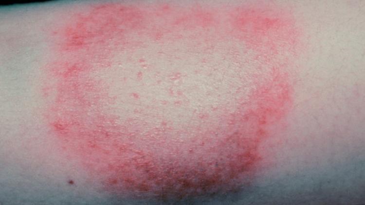 Lyme hastalığı kene ısırığıyla bulaşıyor ve çok tehlikeli