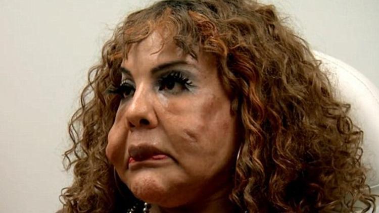 Yasadışı operasyonlarla yüzüne çimento enjekte ettiler... Bakın son hali nasıl oldu...
