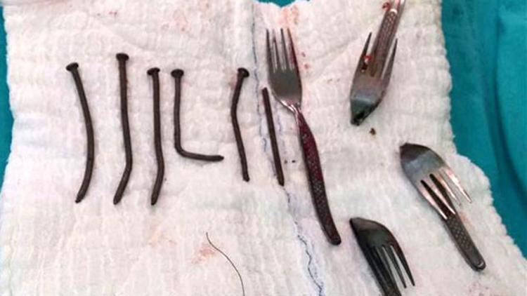 Midesinden çıkanlar şok etti! 6 çivi, 4 çatal