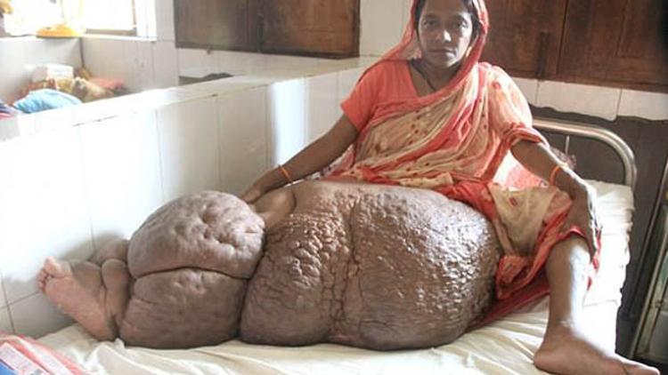 Begüm’ün dramı! Bir bacağı 60 kilo oldu