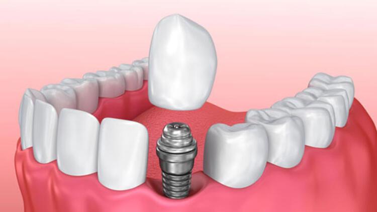 diş implant ile ilgili görsel sonucu