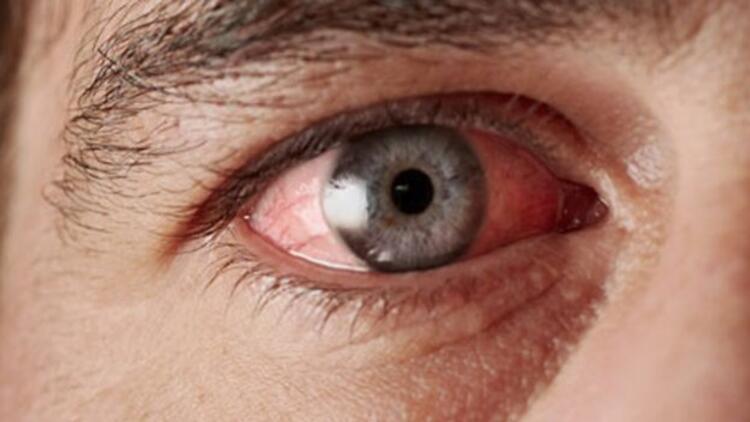 Göz enfeksiyonu nedir, nasıl anlaşılır