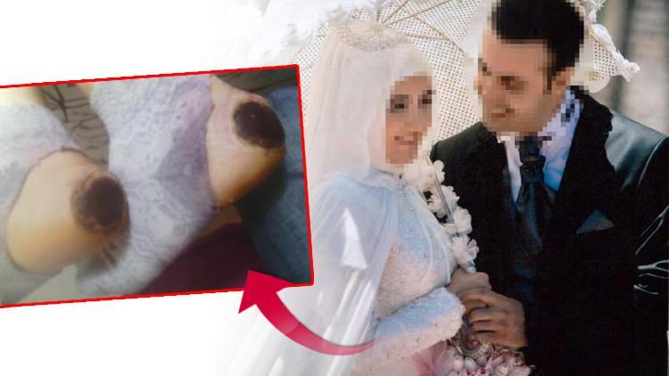 'Topuk yakma' davasında 2 hemşirenin cezası belli oldu