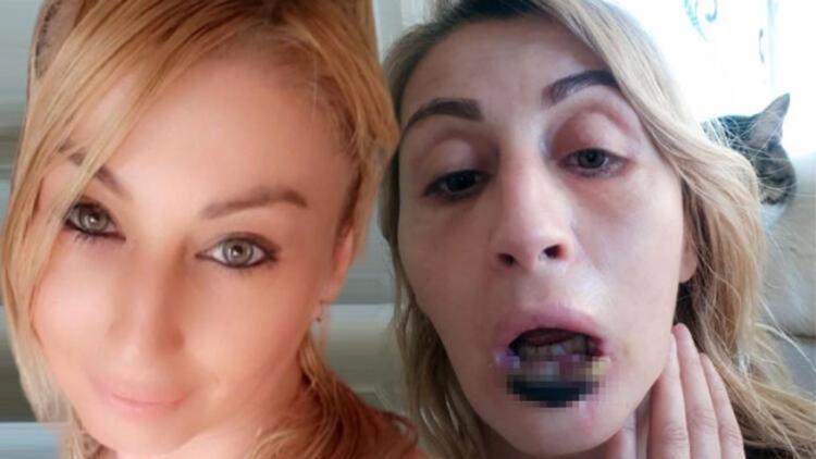 Dudağı çürüyüp düşmüştü! Kötü haber geldi