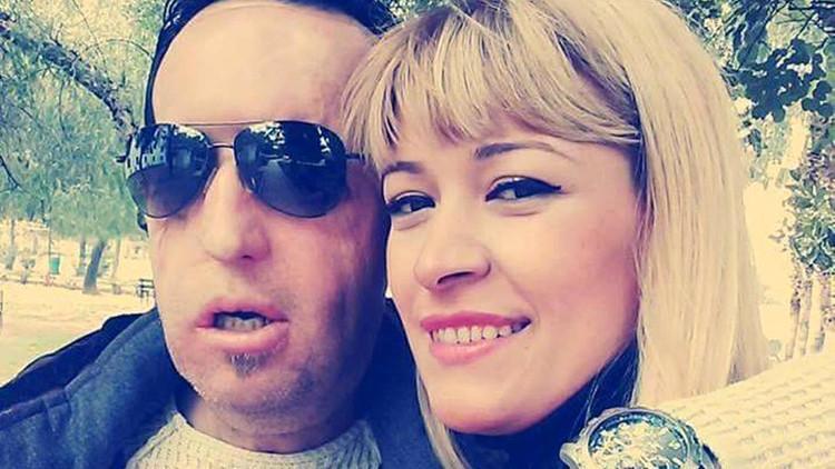Yüz nakilli Recep Sert ile eşi Esma Sert boşanıyor!