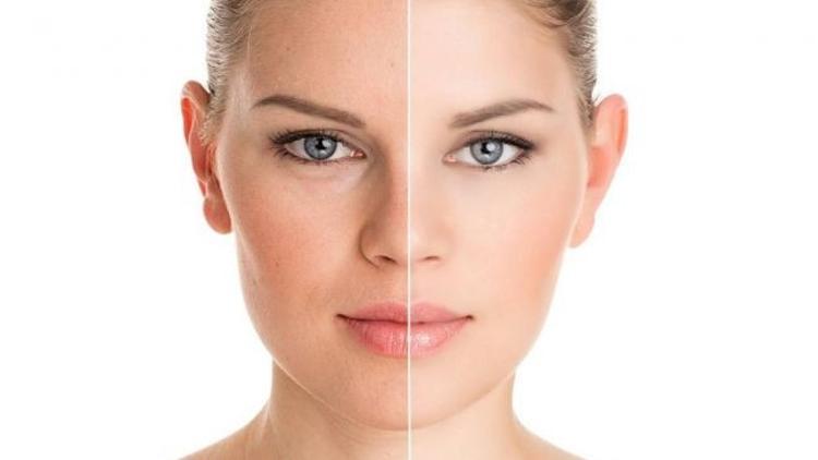 Cilt gençleştirmede yeni trend: Dermaterapi