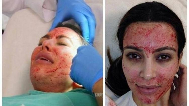 Kendi kanıyla yüzünü gençleştirdi
