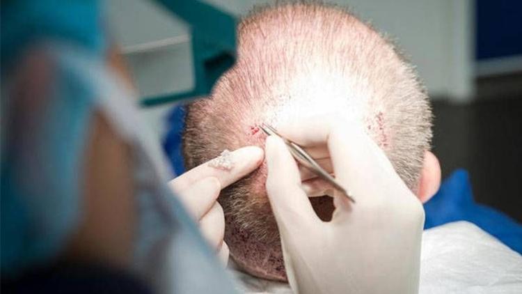 DHI saç ekimi nedir?