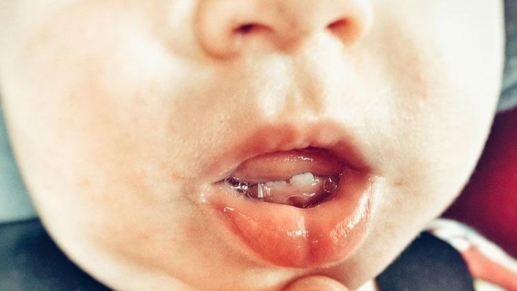 Defne bebek dişleriyle dünyaya geldi