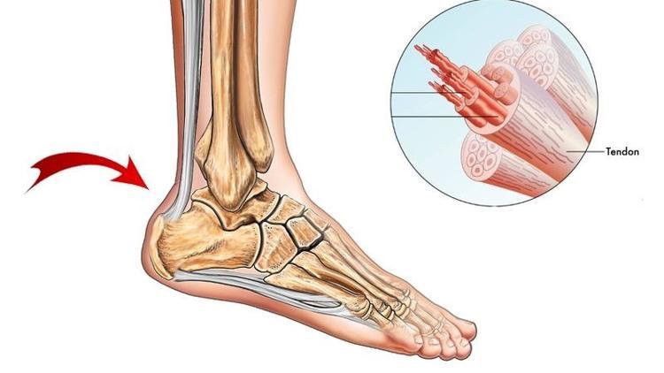 Aşil tendon yaralanması nasıl tedavi edilir?