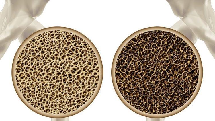 Kemik erimesi (Osteoporoz) nedir? Osteoporoz önlenebilir mi?