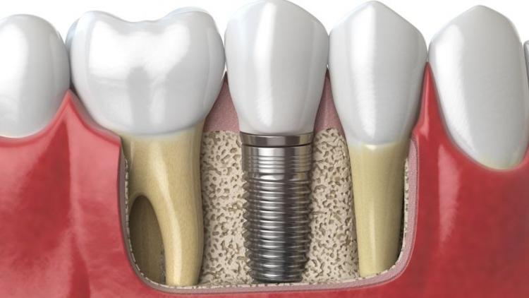 Ağrısız implant mümkün mü?