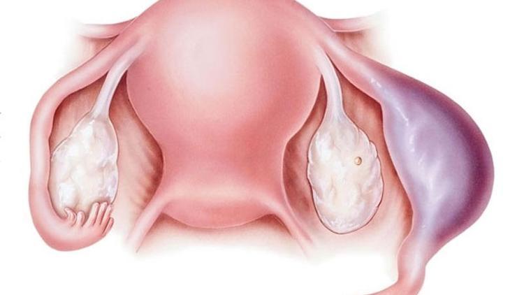 Dış gebelik nedir? Dış gebelik neden olur?